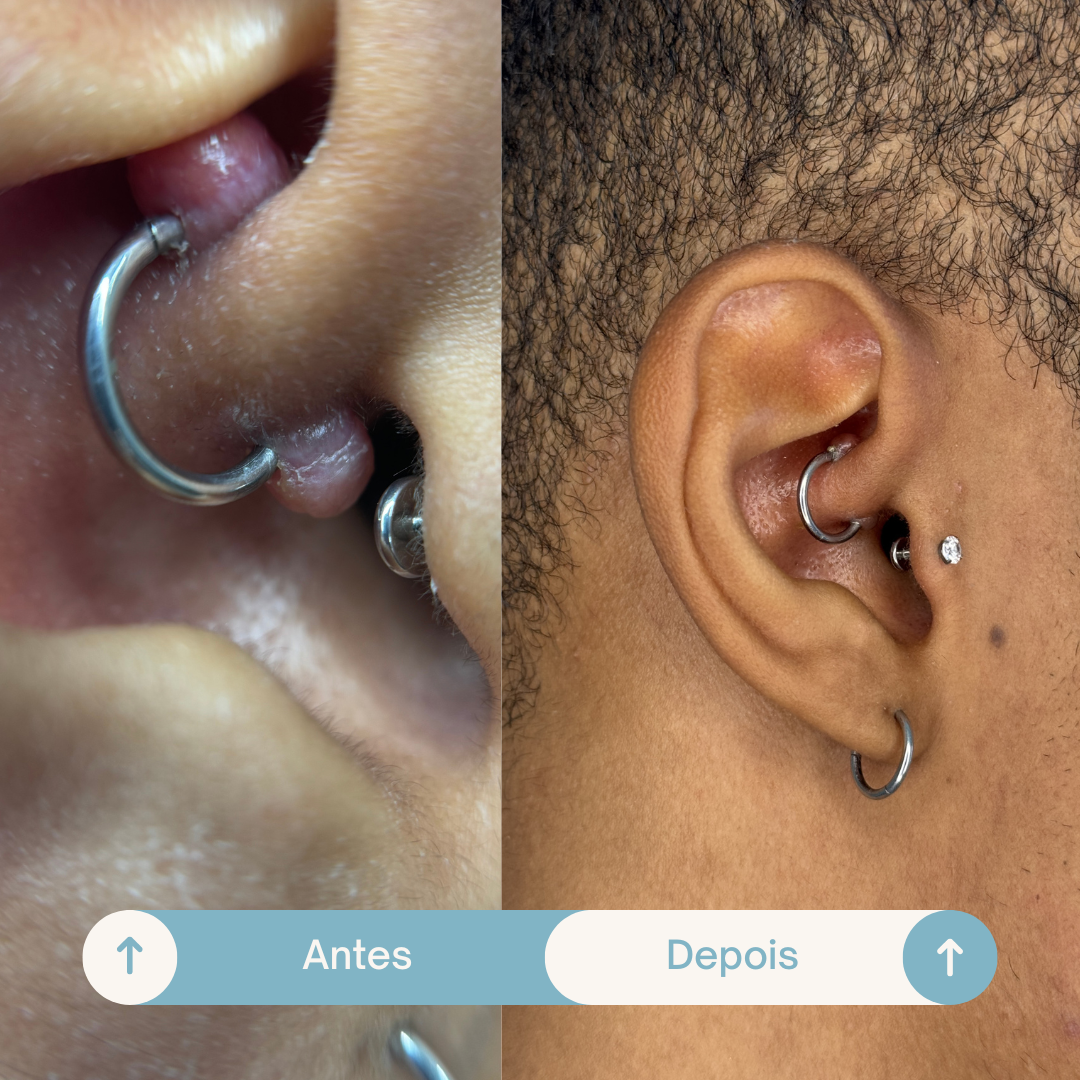 Antes e depois de perfuração tratada com laserterapia