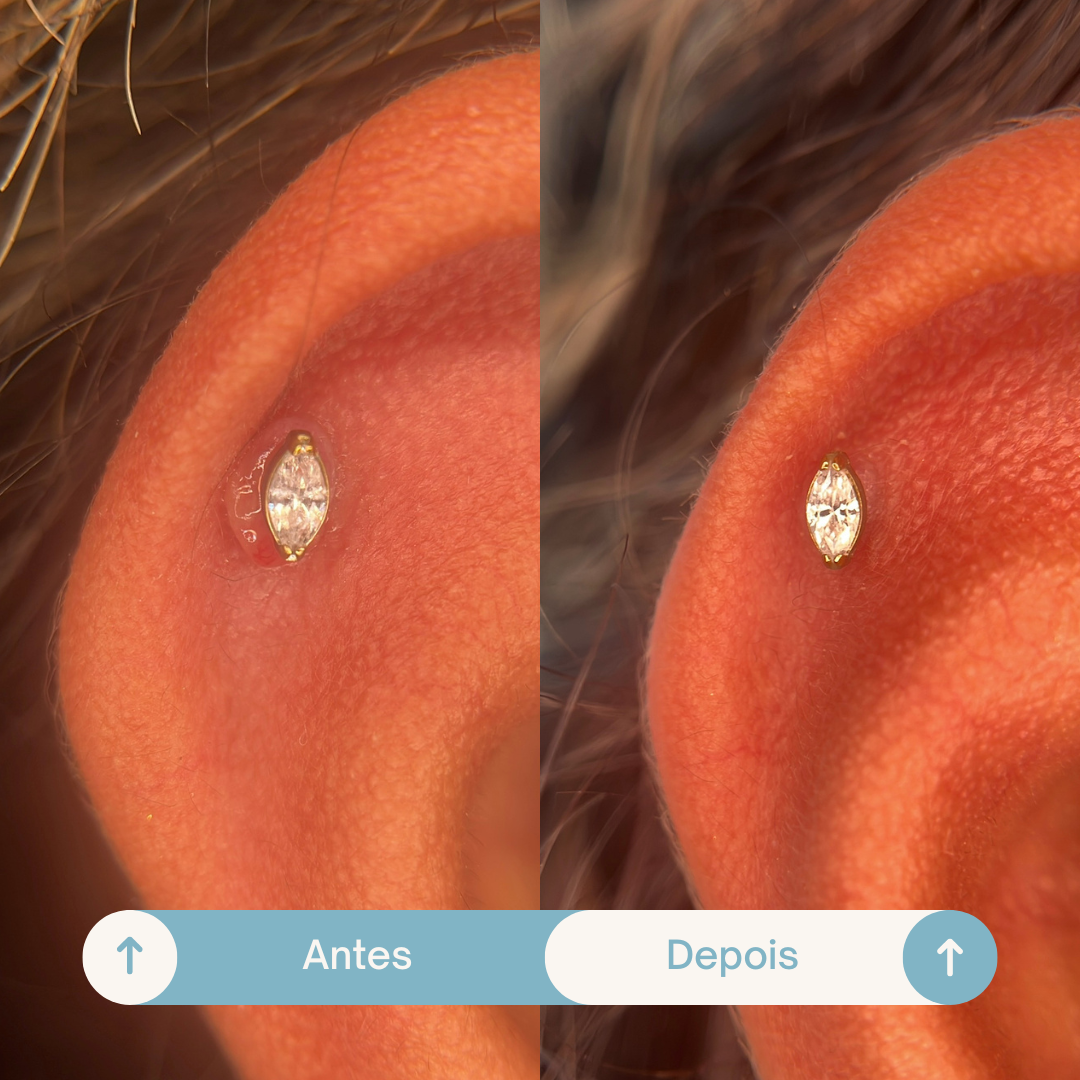 Antes e depois de piercing com granuloma tratado a laser