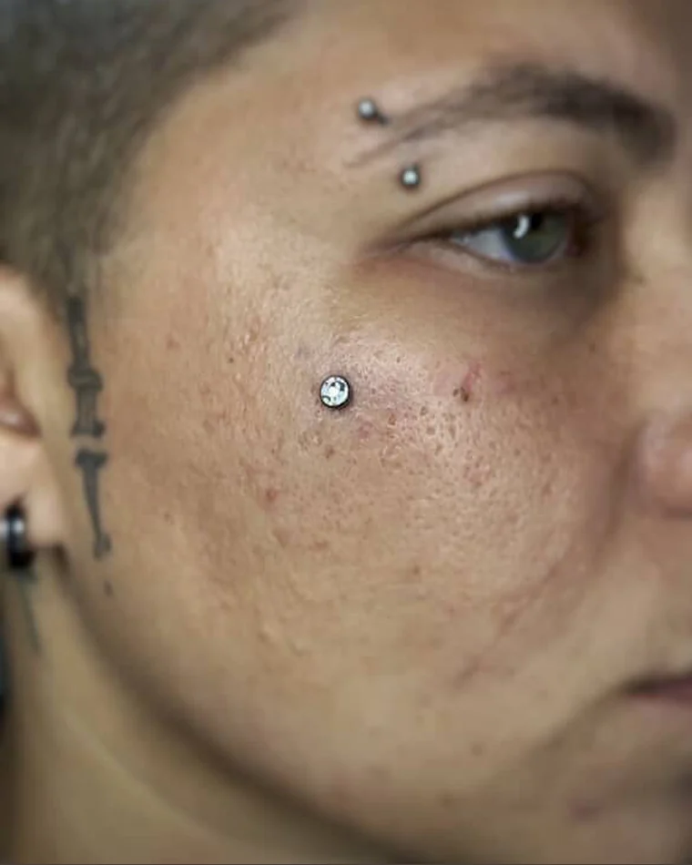 Microdermal no rosto feito por aluna da Maria
